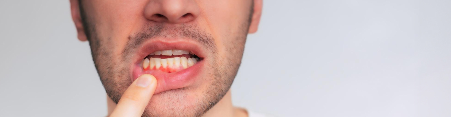 Man pointing to inflamed, swollen gums showing common symptoms of periodontal gum disease.
